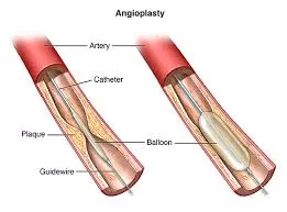 Coronary Angioplasty and Stenting by Dr Vempala Shreeya in Bengaluru