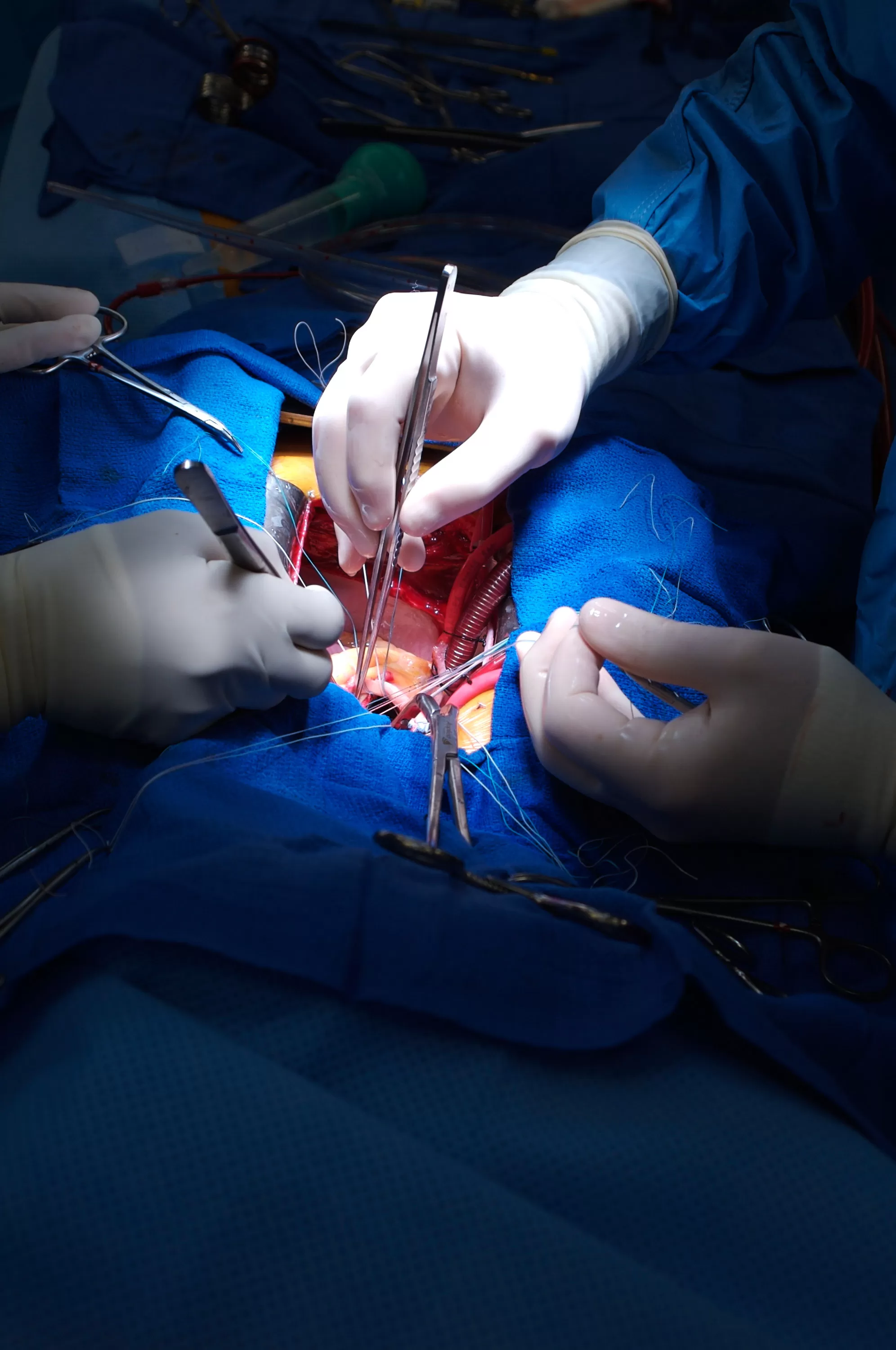 Cardiac Bypass Surgery by Dr Vempala Shreeya in Bengaluru