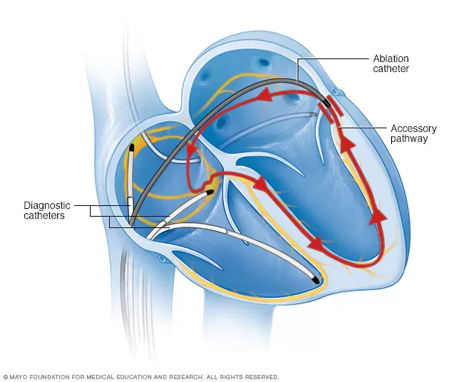 Arrhythmia Treatment by Dr Vempala Shreeya in Bengaluru